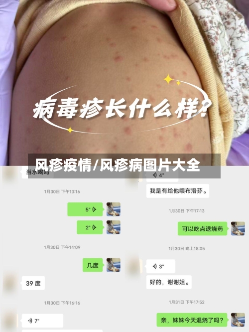 风疹疫情/风疹病图片大全-第1张图片