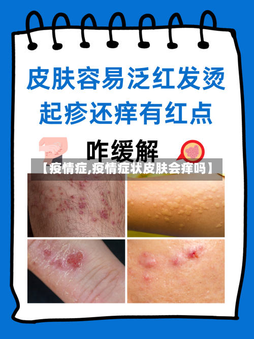 【疫情症,疫情症状皮肤会痒吗】-第1张图片