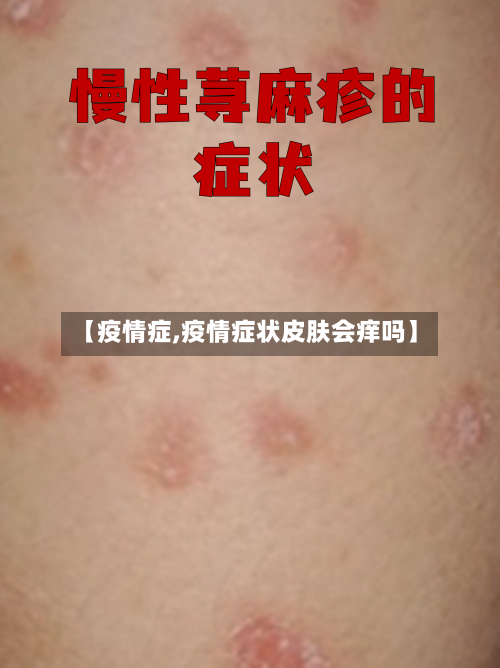 【疫情症,疫情症状皮肤会痒吗】-第2张图片