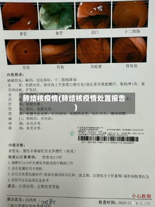 肺结核疫情(肺结核疫情处置报告)-第2张图片